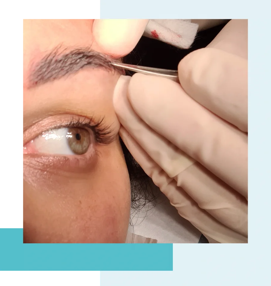 greffe de sourcils