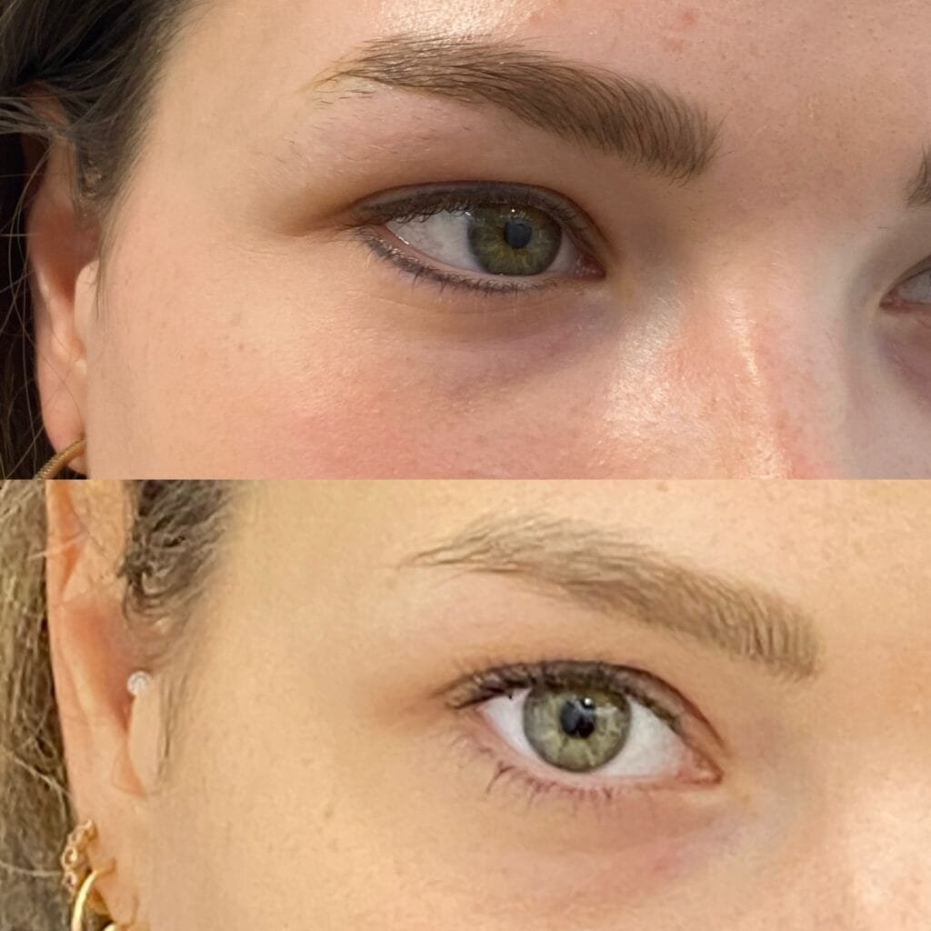 Détatouage laser de l’eyeliner - Crédit : Doctor & Co