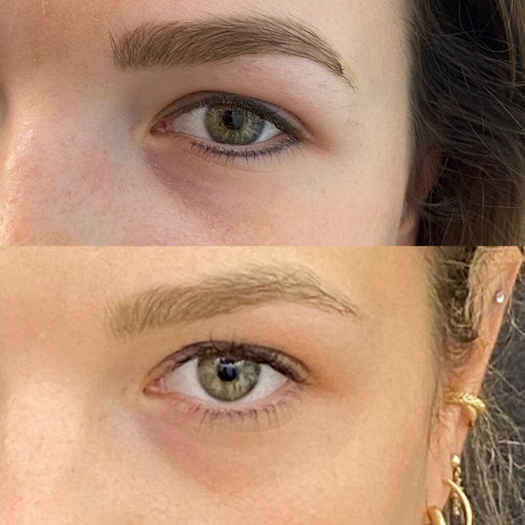 Détatouage laser de l’eyeliner - Crédit : Doctor & Co