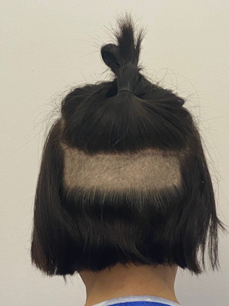 rasage greffe de cheveux