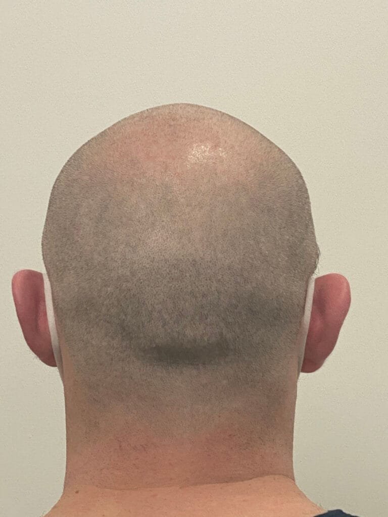 rasage greffe de cheveux