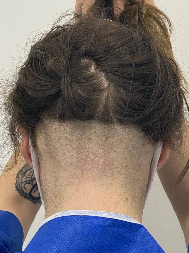 rasage greffe de cheveux