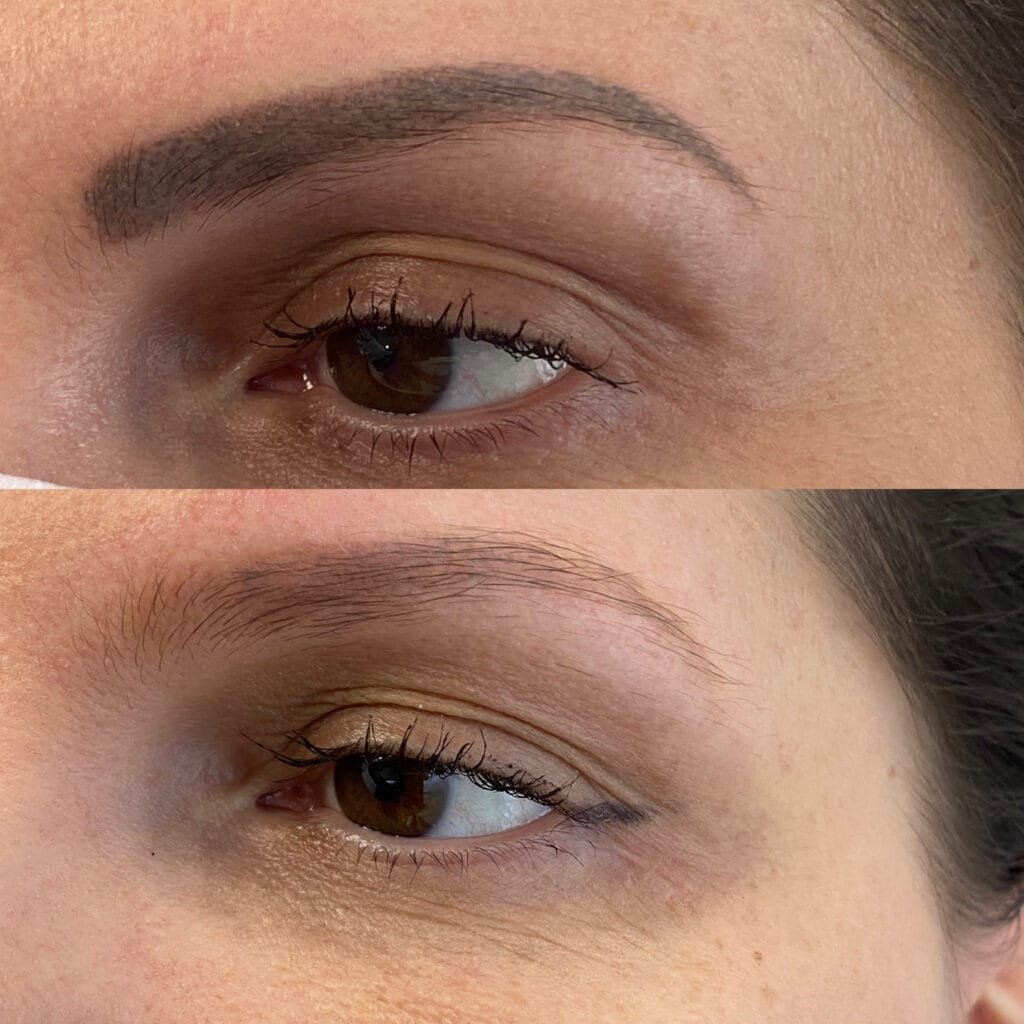 Le détatouage des sourcils