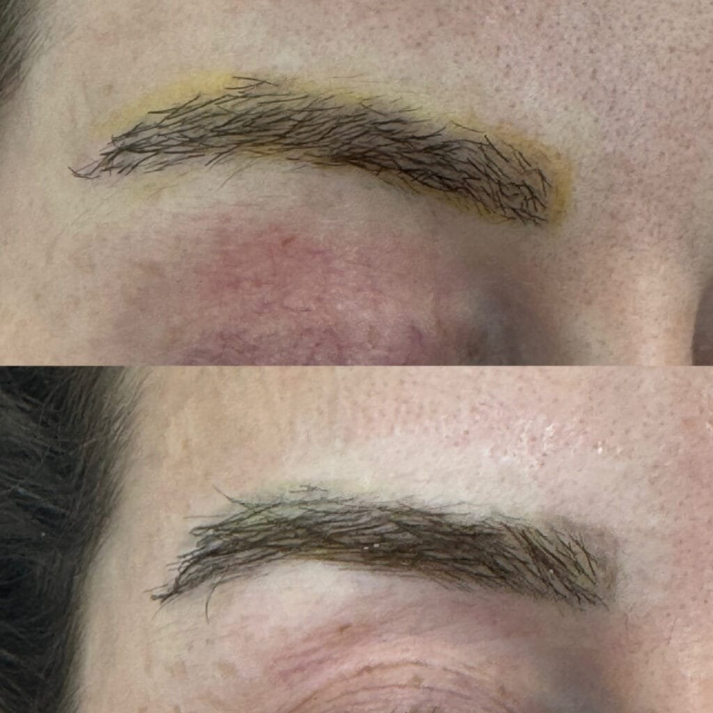 Le détatouage des sourcils