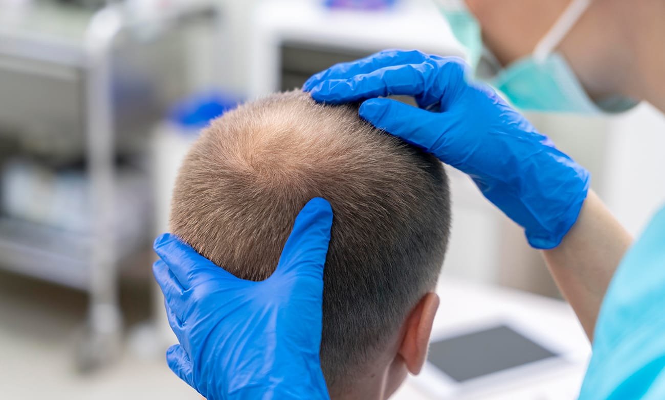 rasage greffe de cheveux